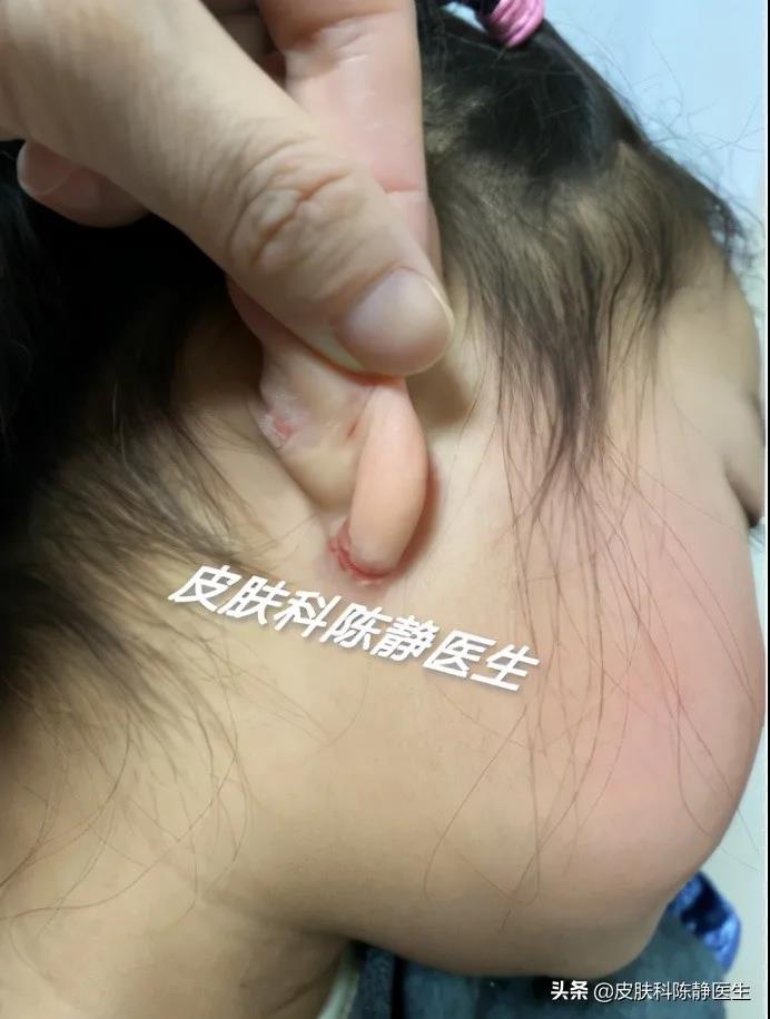 患者故事｜请帮帮我的孩子--儿童“湿疹”反复不愈？“特应性皮炎”是真凶