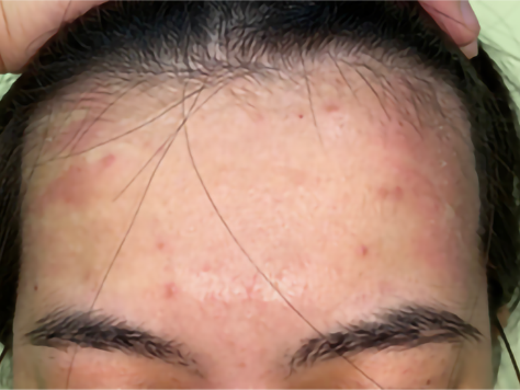 患者故事｜皮损全消，不是梦！