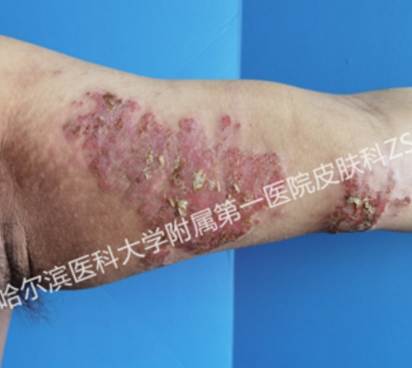 患者故事|东北男孩的向往生活