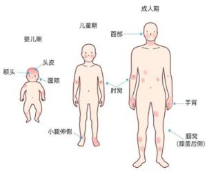 特应性皮炎的诊断和治疗