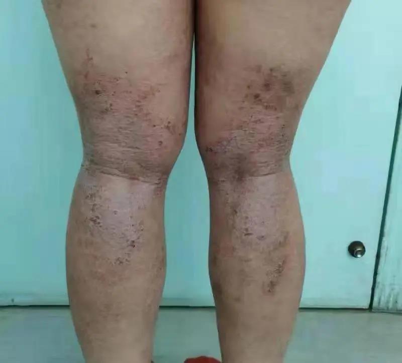 患者故事 | 一份价值百万的生物制剂offer
