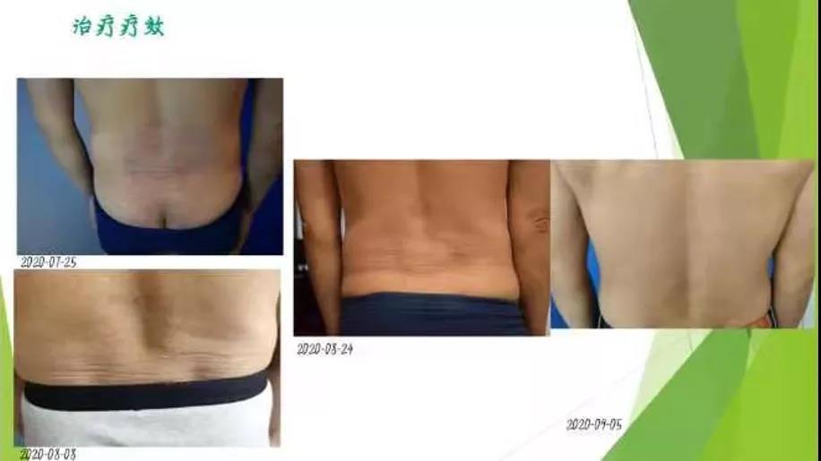 患者故事|一位医生与特应性皮炎的斗争史