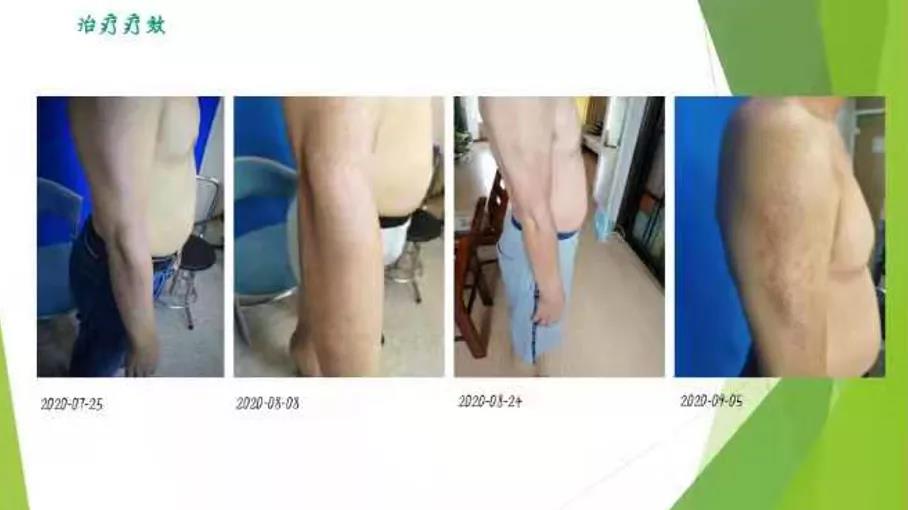 患者故事|一位医生与特应性皮炎的斗争史