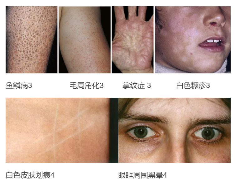 解惑AD | 老患者都说不上来的AD特征，你知道吗？
