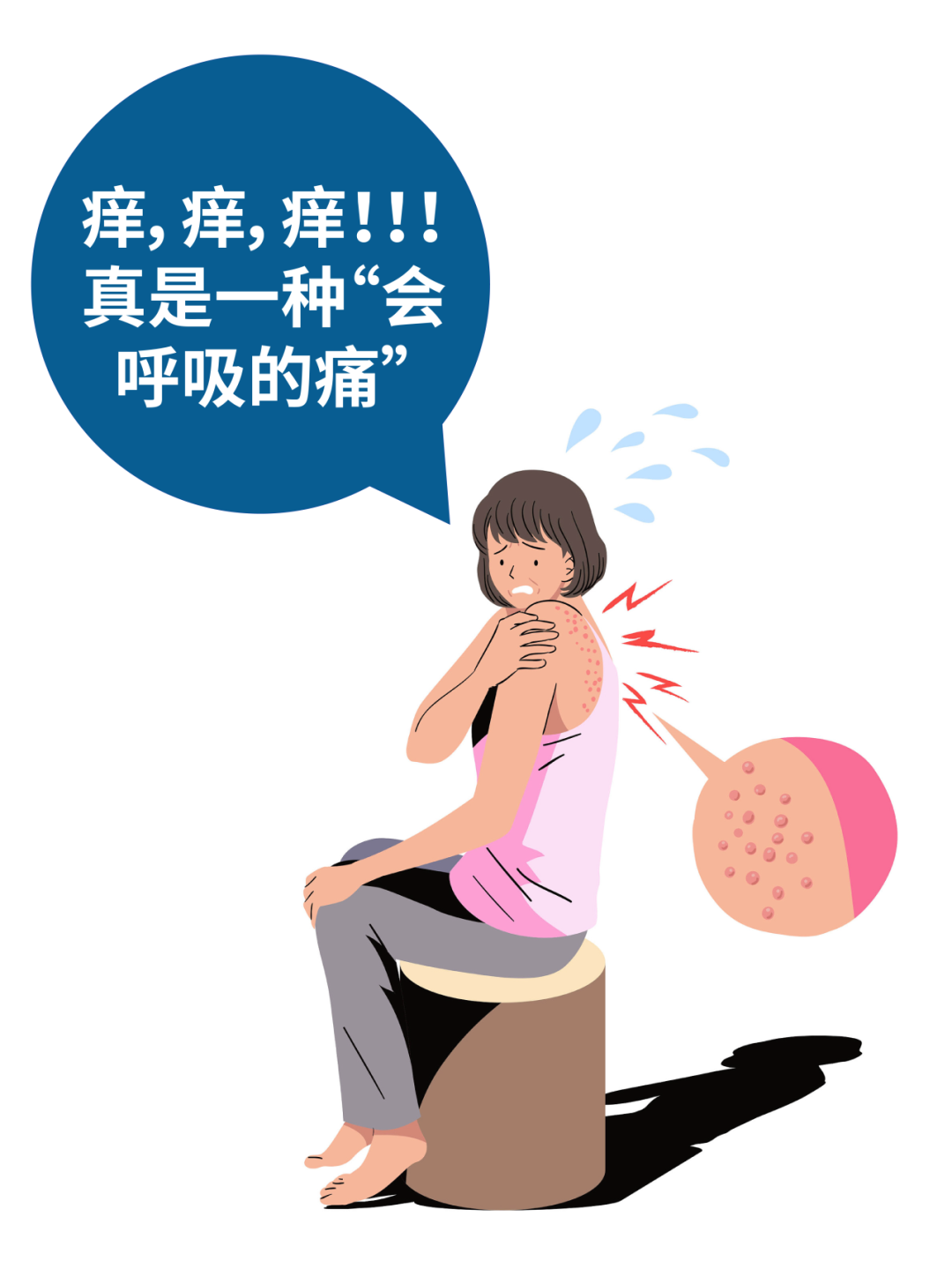 慢性瘙痒性疾病中“瘙痒之最” —— 结节性痒疹