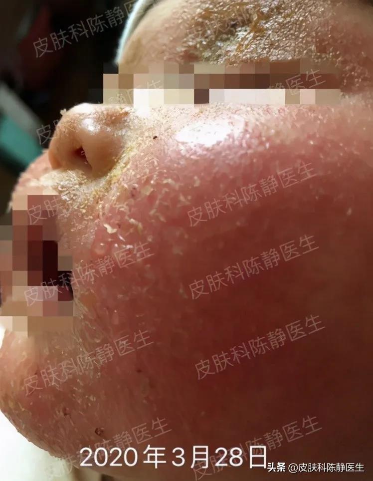 患者故事｜请帮帮我的孩子--儿童“湿疹”反复不愈？“特应性皮炎”是真凶