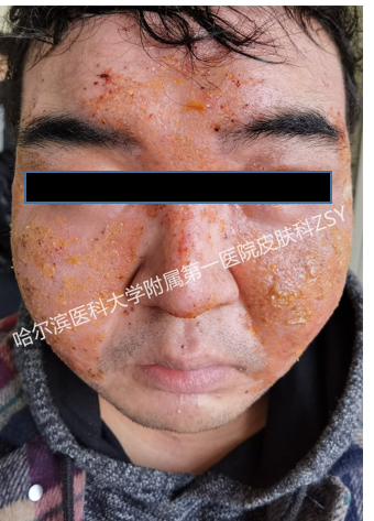 患者故事|东北男孩的向往生活