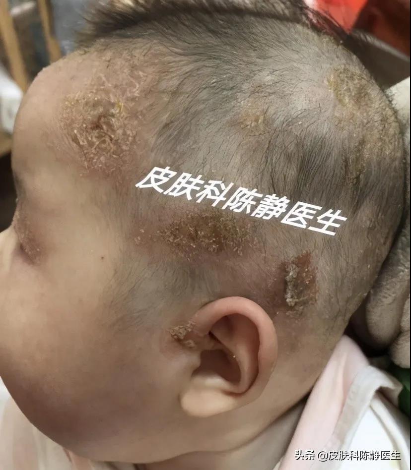 患者故事｜请帮帮我的孩子--儿童“湿疹”反复不愈？“特应性皮炎”是真凶