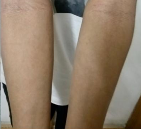 患者故事|“平凡”女孩的心路历程