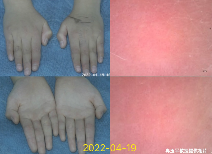 患者故事｜一个家庭的故事，一颗希望的种子