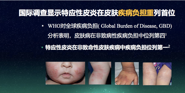 疾病负担在非致命皮肤病里列第一，中国特应性皮炎患者生存状况调研报告发布