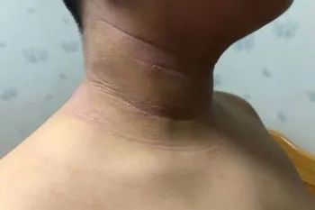 患者故事|AD家庭的凌晨四点