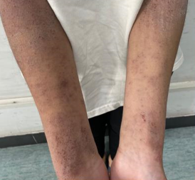 患者故事|“平凡”女孩的心路历程
