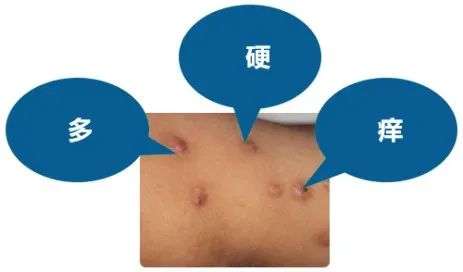 慢性瘙痒性疾病中“瘙痒之最” —— 结节性痒疹