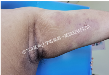 患者故事|东北男孩的向往生活