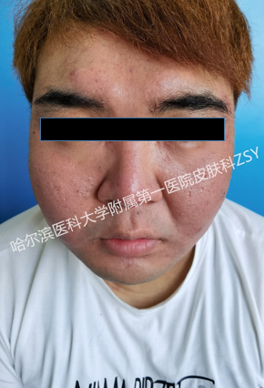 患者故事|东北男孩的向往生活
