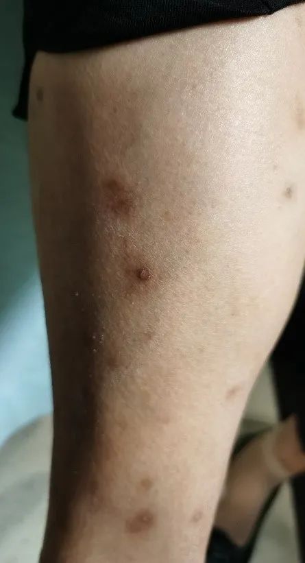 患者故事|让我内疚、让我心疼的AD母亲