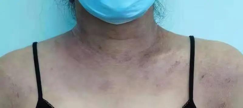 患者故事 | 一份价值百万的生物制剂offer