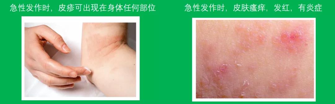 解惑AD | 特应性皮炎(AD)急性发作的那些事