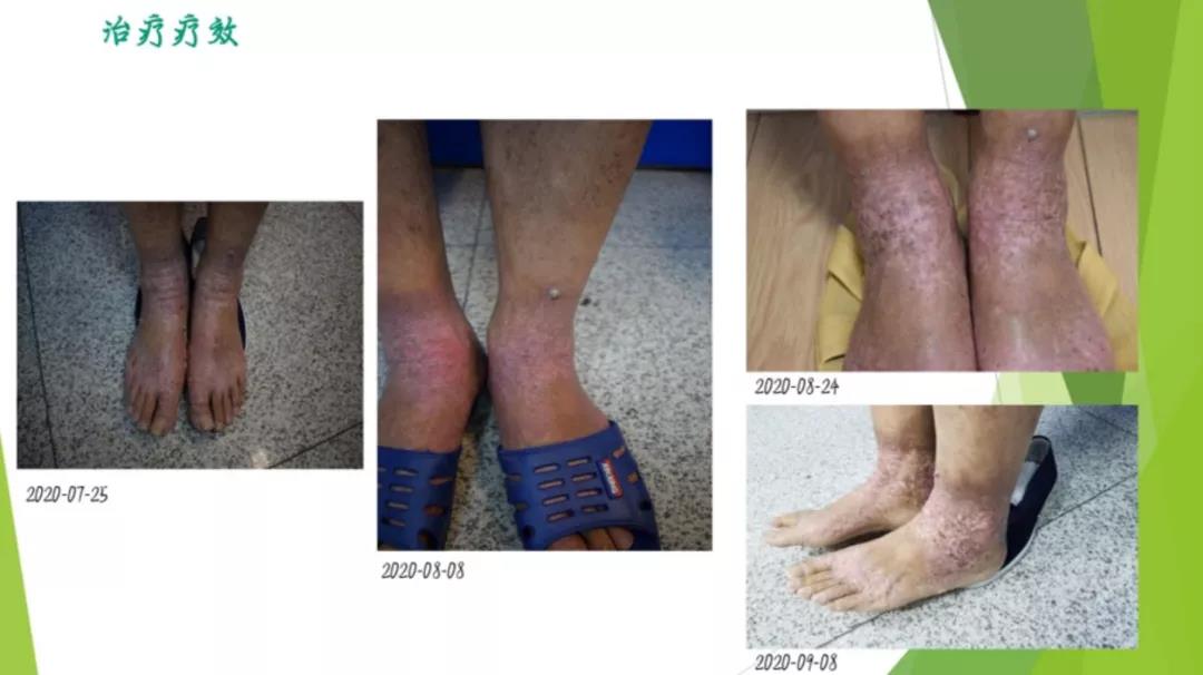 患者故事|一位医生与特应性皮炎的斗争史