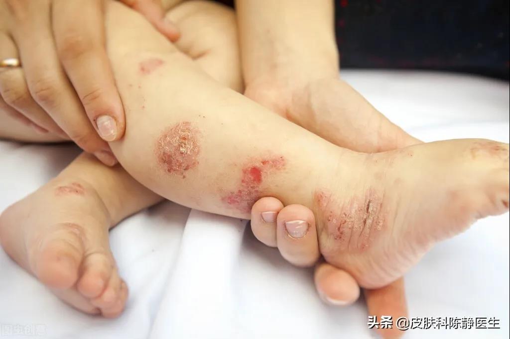 患者故事｜请帮帮我的孩子--儿童“湿疹”反复不愈？“特应性皮炎”是真凶