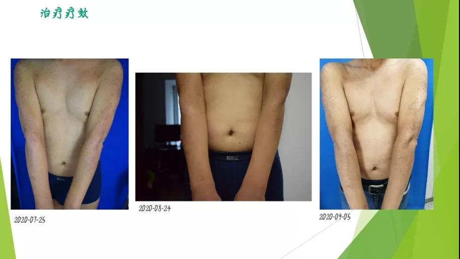 患者故事|一位医生与特应性皮炎的斗争史