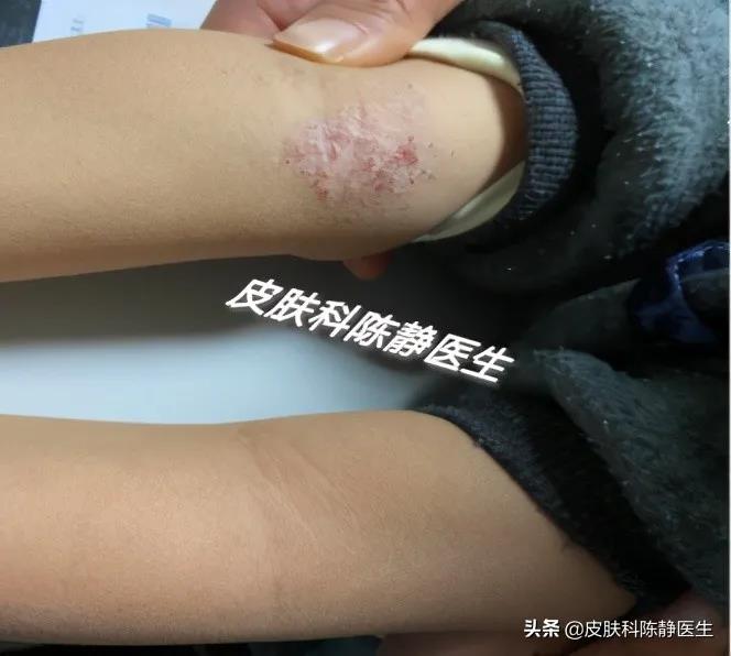 患者故事｜请帮帮我的孩子--儿童“湿疹”反复不愈？“特应性皮炎”是真凶