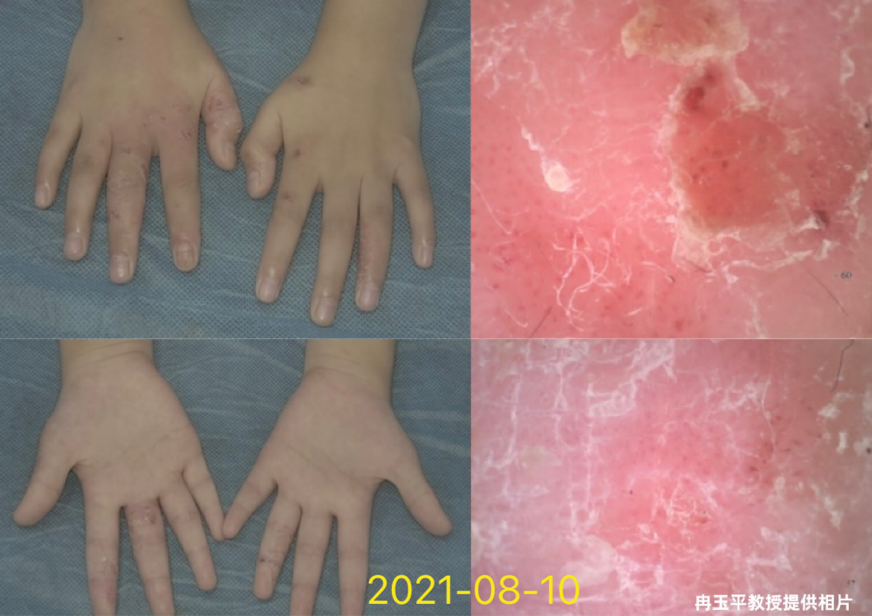 患者故事｜一个家庭的故事，一颗希望的种子