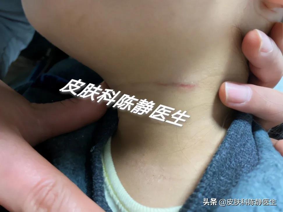 患者故事｜请帮帮我的孩子--儿童“湿疹”反复不愈？“特应性皮炎”是真凶